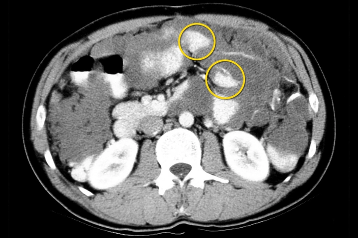Pseudomyxoma Peritonei (PMP)