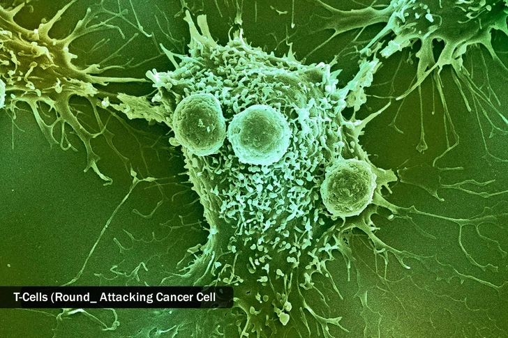 Treatment: Car T-Cell Therapy
