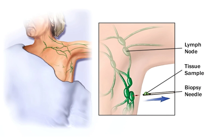 Lymphoma Symptoms and Diagnosis Lymphoma Symptoms and Diagnosis
