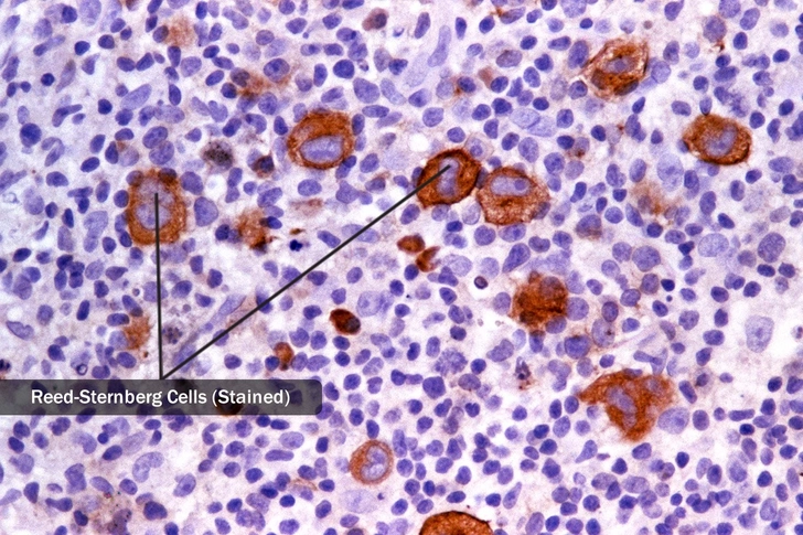 Hodgkin's Lymphoma