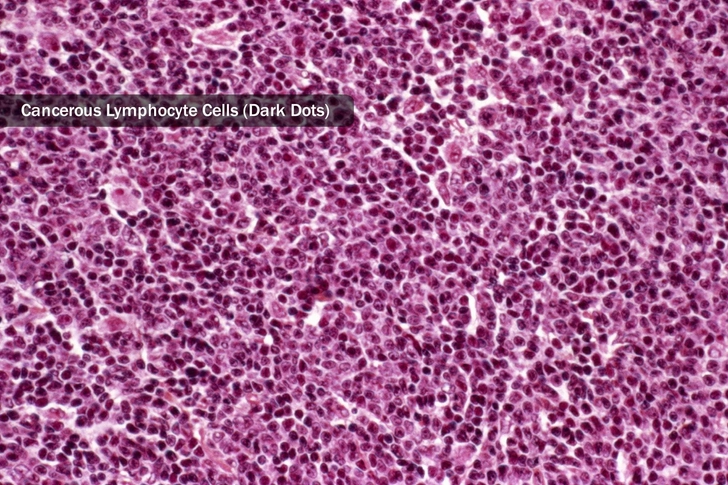 Non-Hodgkin's Lymphoma