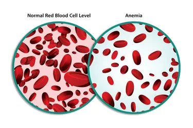 Iron deficiency anemia is when your body doesn’t have enough red blood cells and thus is low in iron. (Photo credit: iStock/Getty Images)