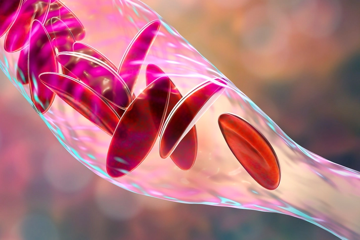 Sickle Cell Disease