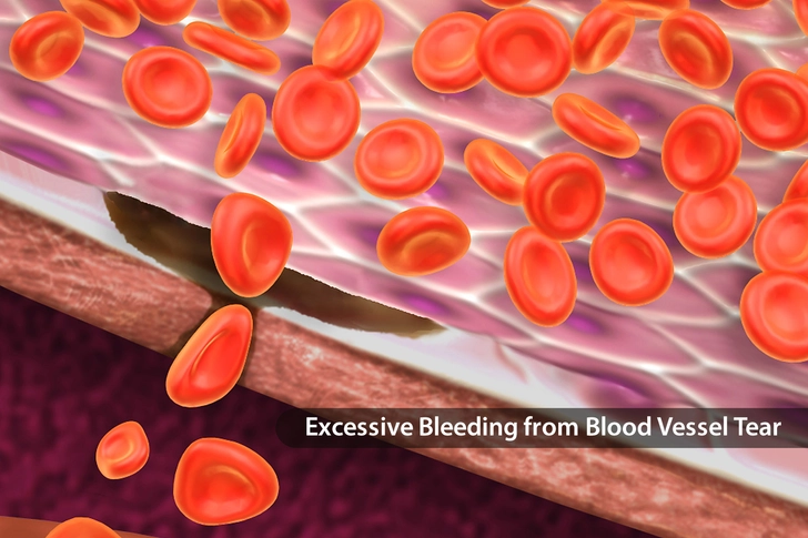 Von Willebrand Disease