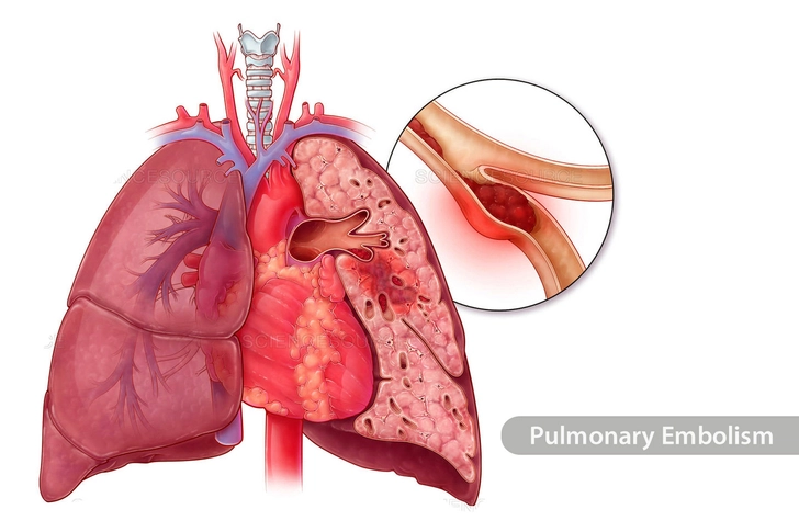 Venous Thromboembolism