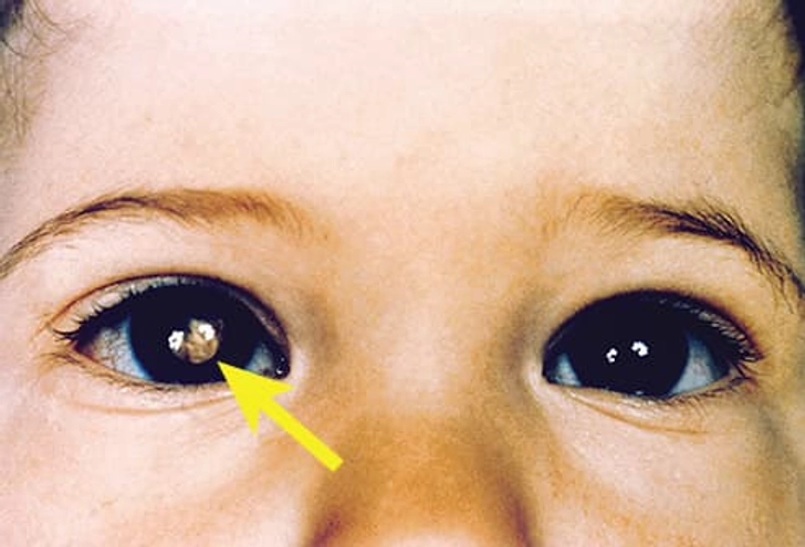 Retinoblastoma