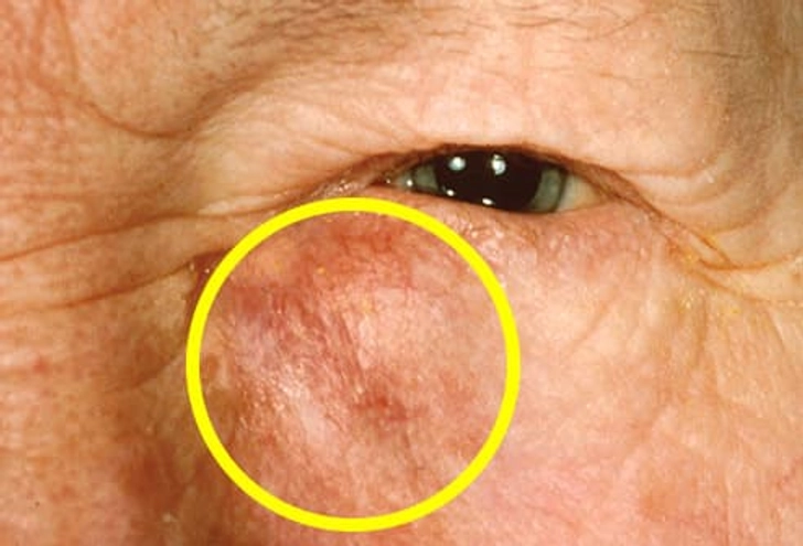 Lacrimal Gland Cancer