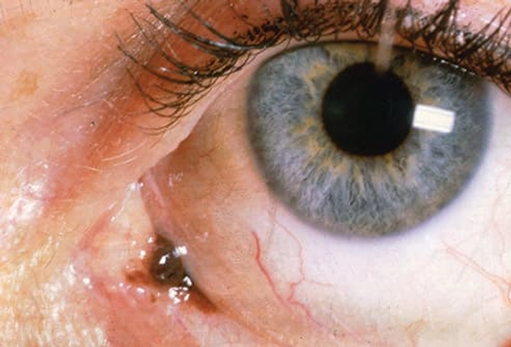 Conjunctival Melanoma Conjunctival Melanoma