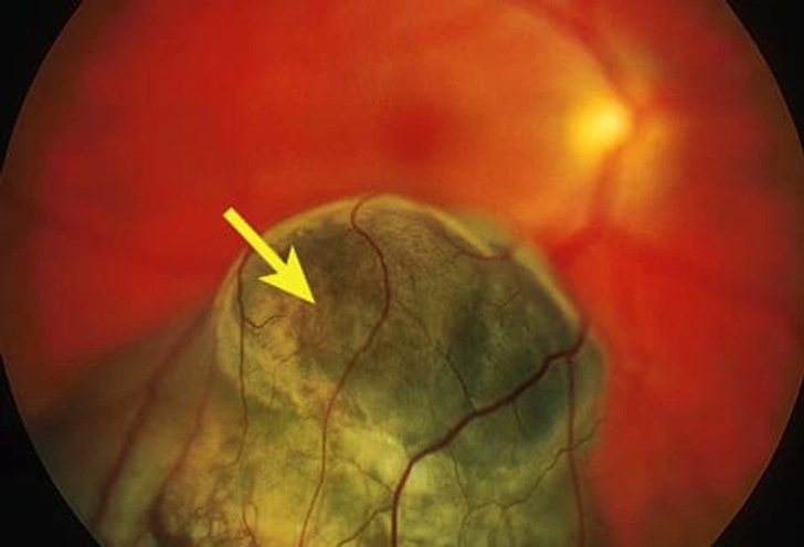 Uveal Melanoma