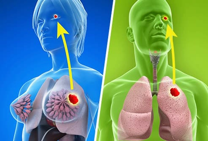 Secondary Eye Cancer
