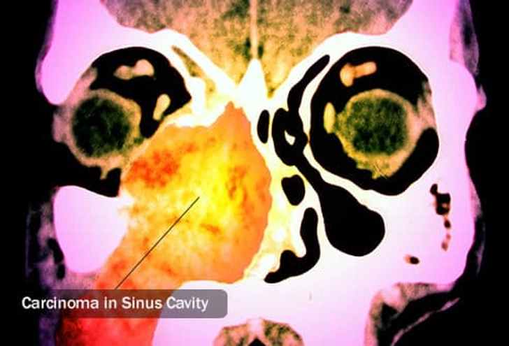 Type: Nasal Cavity Cancer Type: Nasal Cavity Cancer