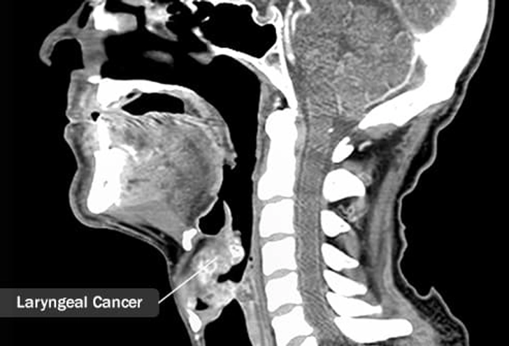 Type: Laryngeal Cancer Type: Laryngeal Cancer