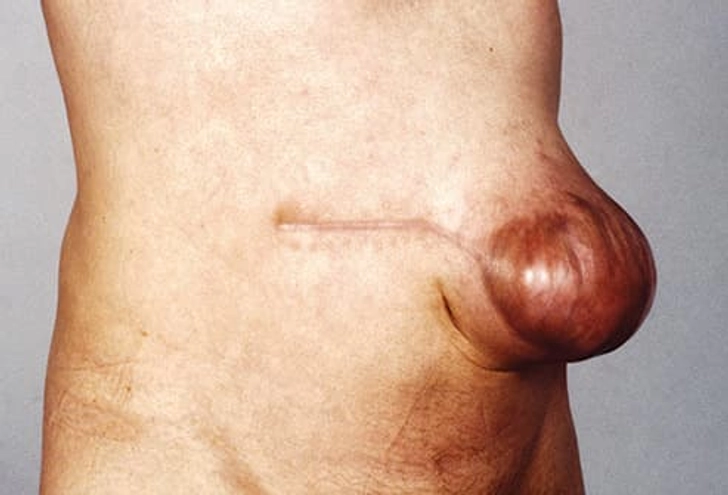 Incisional Hernias Incisional Hernias