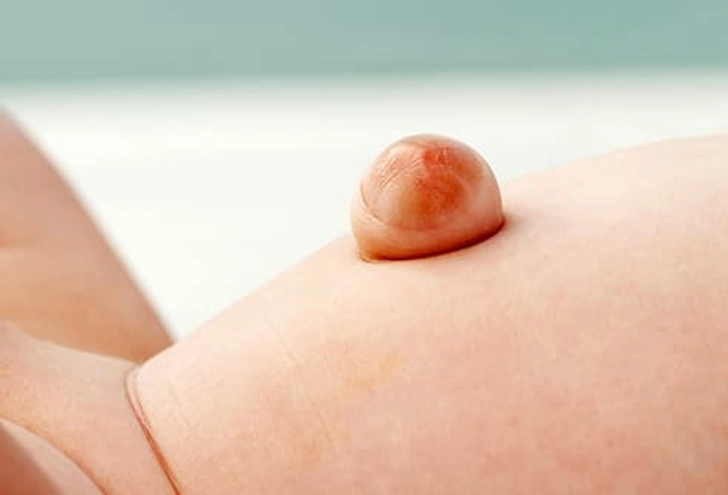 Hernias in Children Hernias in Children