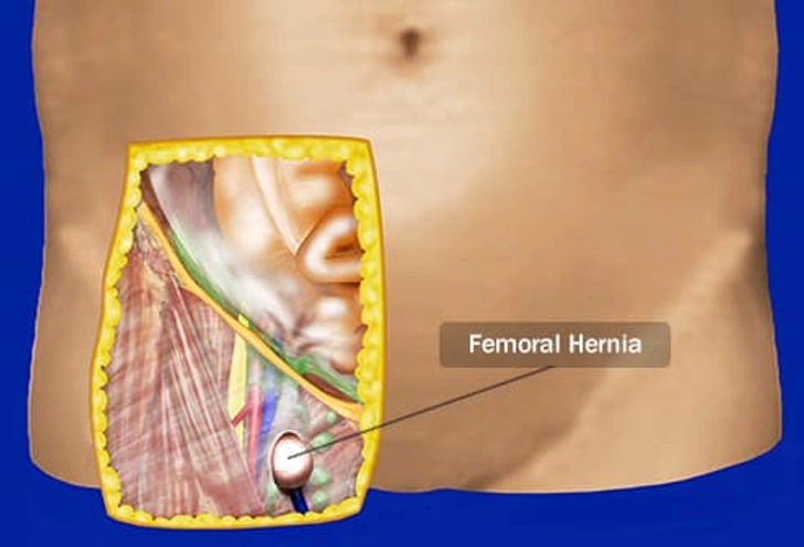 Femoral Hernia Femoral Hernia