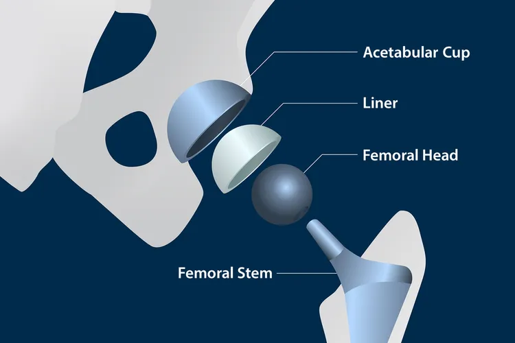 photo of artificial hip components