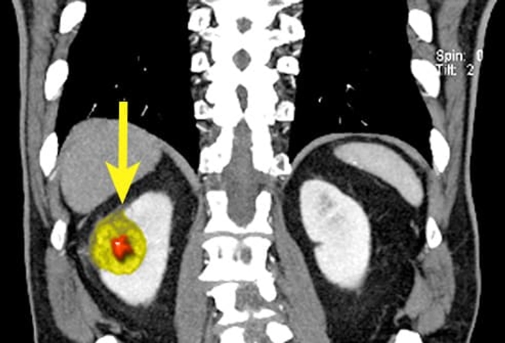 Renal Cell Carcinoma (RCC)