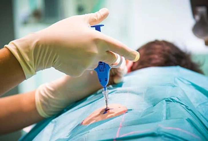 Biopsy
