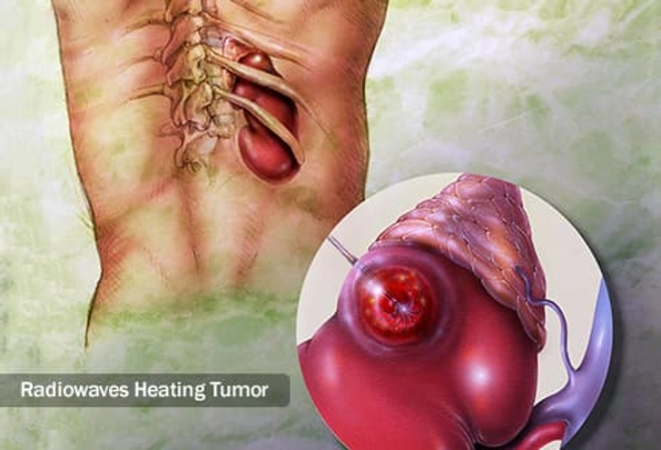 Tumor ‘Destroyers’