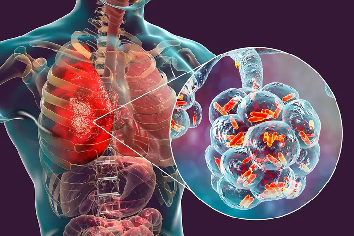 What Is Legionnaires’ Disease? What Is Legionnaires’ Disease?