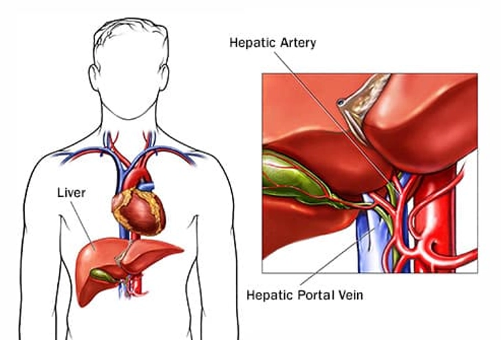 Treatment: Embolization Therapy Treatment: Embolization Therapy