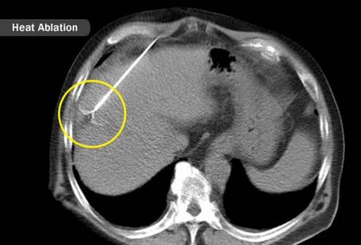 Treatment: Ablation Therapy Treatment: Ablation Therapy
