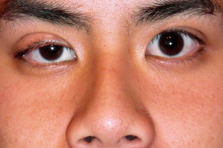 Symptoms: Your Eyes Symptoms: Your Eyes