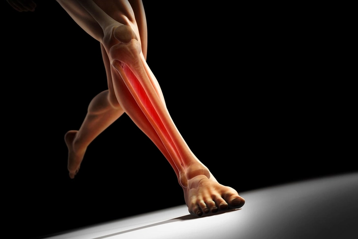 Shin Splints