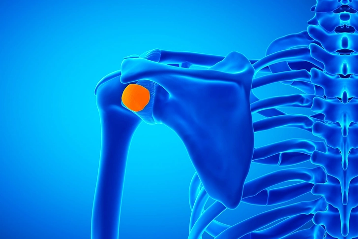 Shoulder Bursitis Shoulder Bursitis