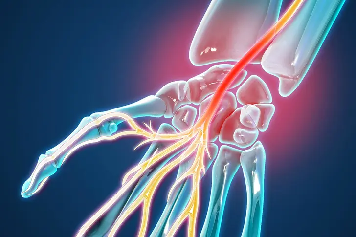 Carpal Tunnel Syndrome
