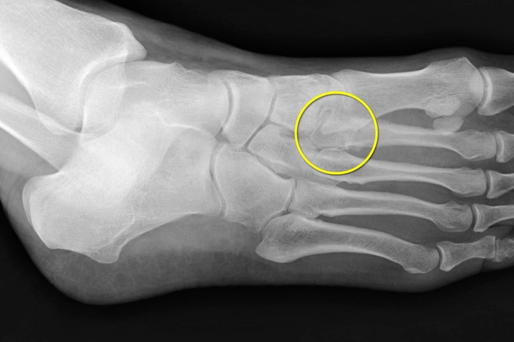 Stress Fractures