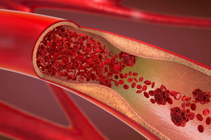 Heart Disease Heart Disease