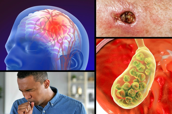 Complications of Sickle Cell Disease Complications of Sickle Cell Disease