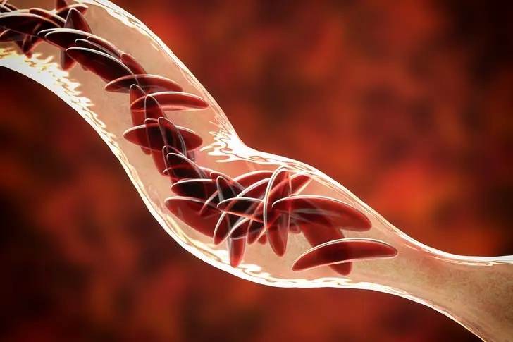 What is Sickle Cell Disease?