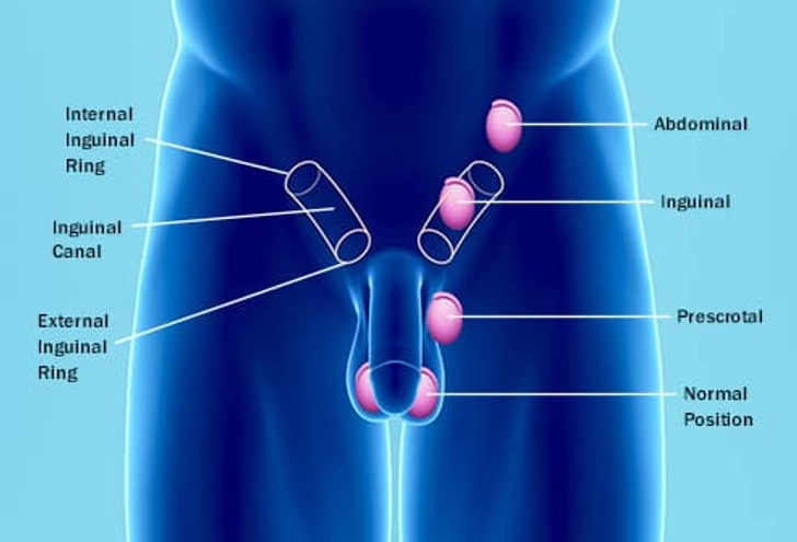 An Undescended Testicle