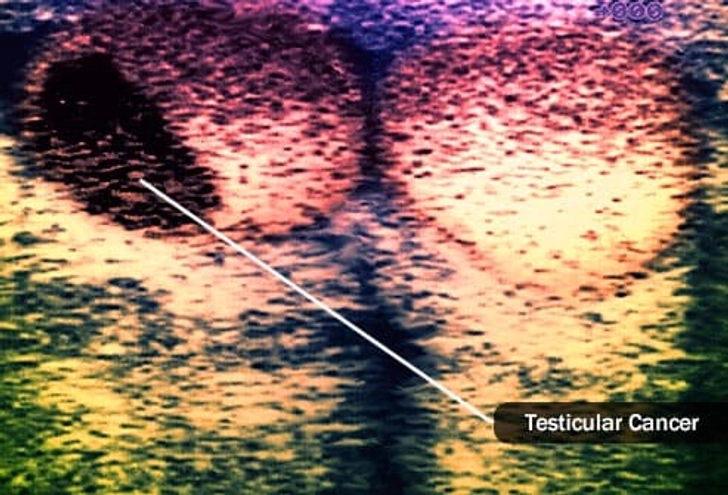 How It’s Diagnosed: Ultrasound and Surgery