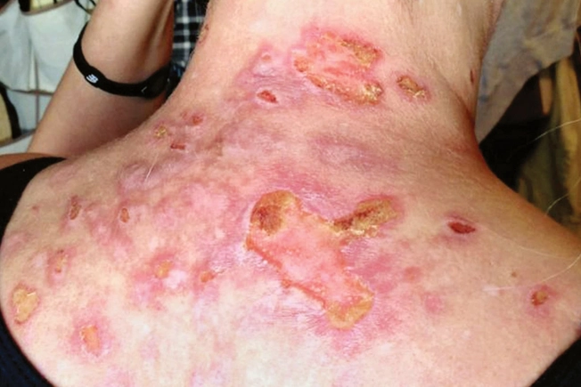 Morgellons Disease