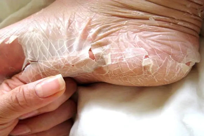 Peeling Skin Syndrome