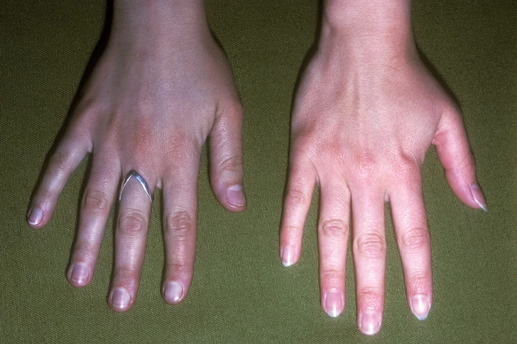 Argyria