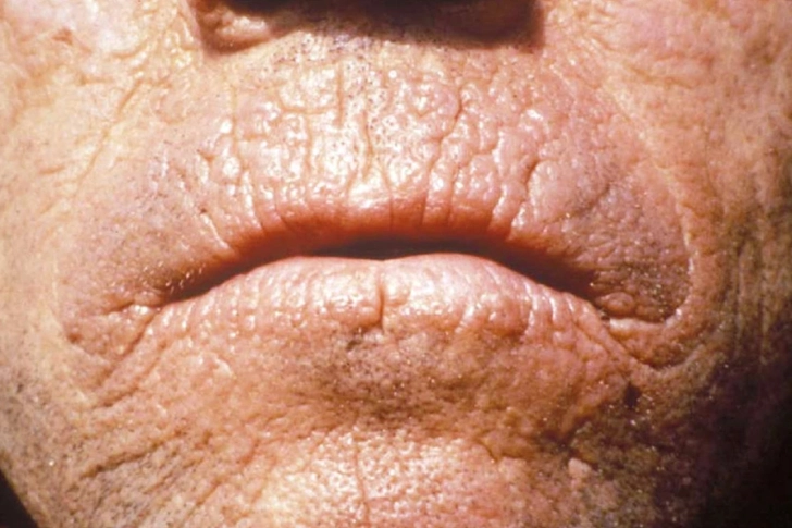Erythropoietic Protoporphyria Erythropoietic Protoporphyria