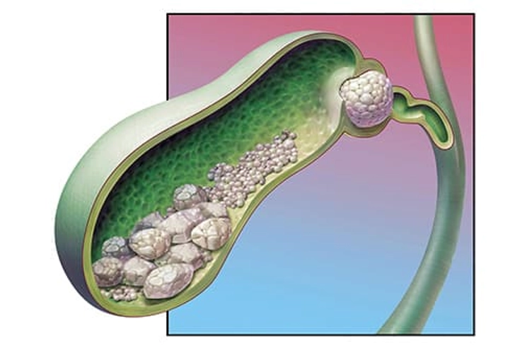 Gallstones