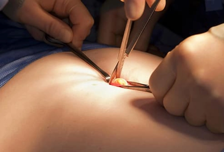 Treatment for Cholecystitis