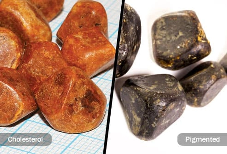 Types of Gallstones