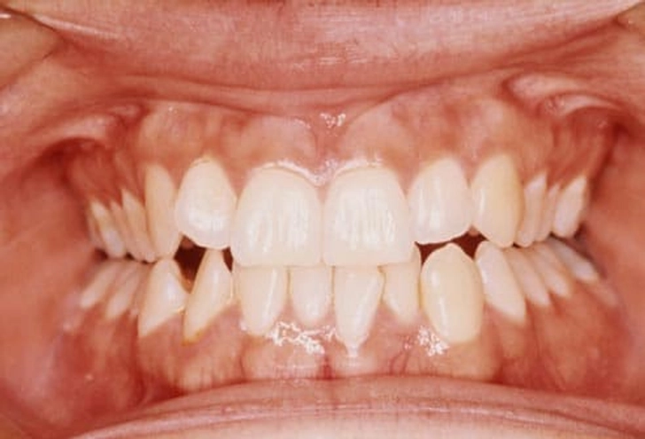 Grinding Teeth