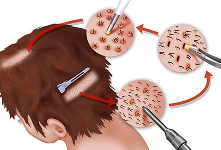 Hair Transplants in Women