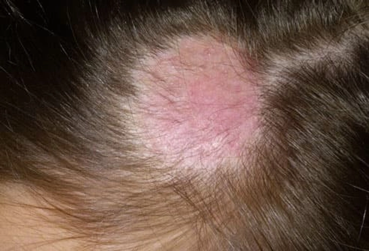 Hair Loss Trigger: Ringworm