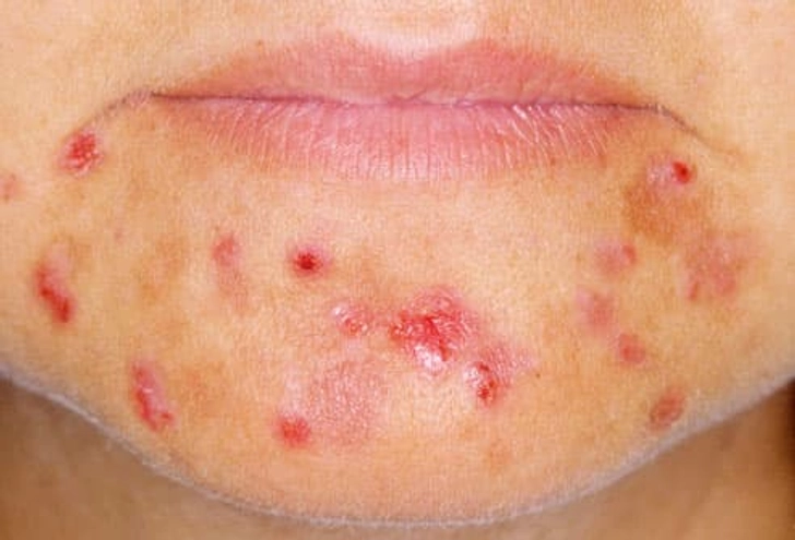 Hair Loss Trigger: PCOS Hair Loss Trigger: PCOS