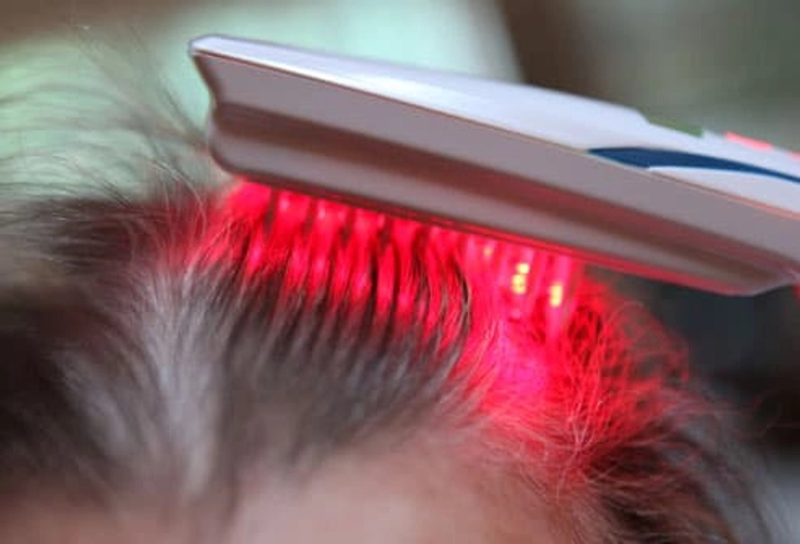 Treating Hair Loss: Lasers