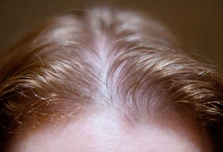 Hair Loss Isn’t Just a Guy Thing