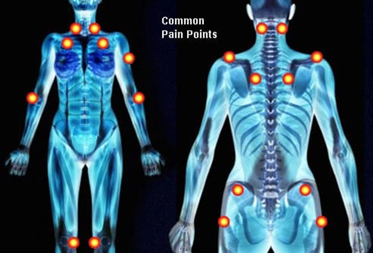 Fibromyalgia Fibromyalgia